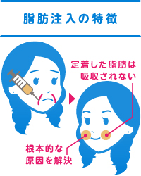 顔のたるみの根本的な改善と定着した脂肪は吸収されないという脂肪注入の特徴