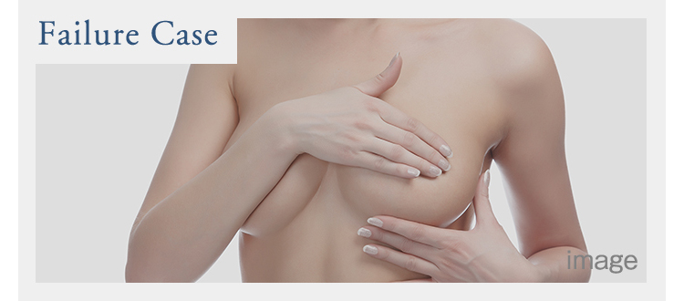 豊胸手術の失敗15例を実際の画像で解説します 美容外科の医師監修コラム