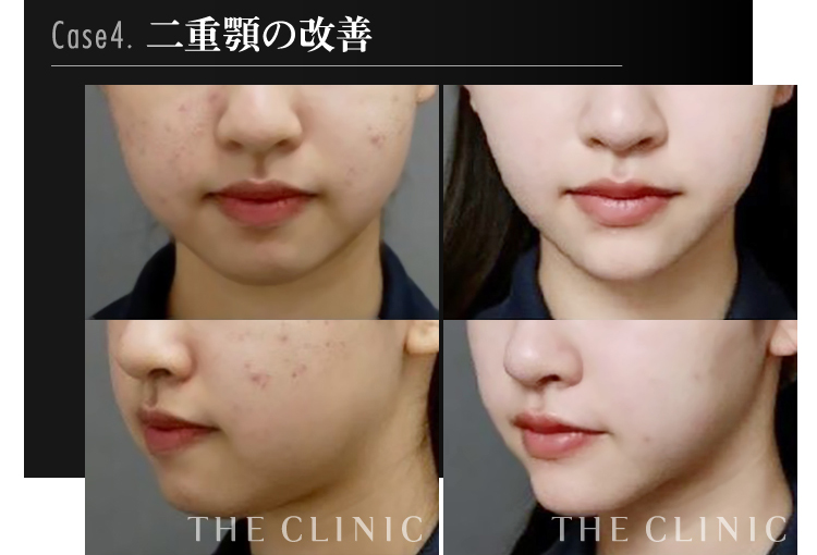 バッカルファット除去をお勧めしない理由 実際の失敗画像とともに解説 美容外科の医師監修コラム