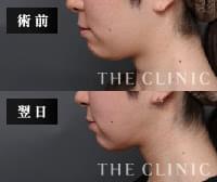 顔の脂肪吸引の腫れやむくみが分かる術前後の比較画像