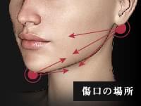顔の脂肪吸引の傷の場所