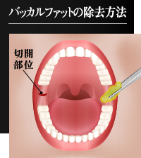 バッカルファット除去手術の方法