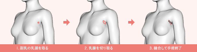 副乳治療で乳腺切除を伴う場合