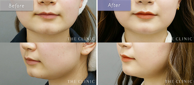 女性の割れ顎整形の症例