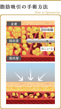 脂肪吸引の手術方法