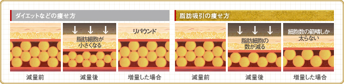 ダイエットと脂肪吸引の違い