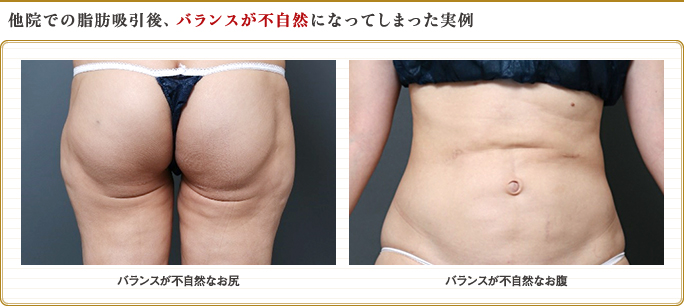 脂肪吸引後、バランスが不自然になったお尻・お腹