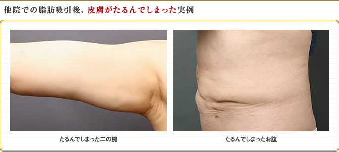 脂肪吸引後、皮膚がたるんでしまった二の腕・お腹