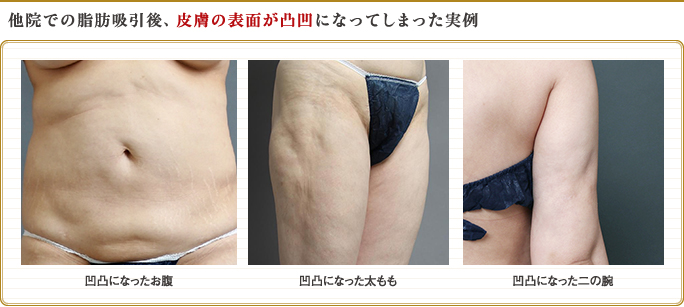 脂肪吸引後、皮膚の表面が凸凹になったお腹・太もも・二の腕