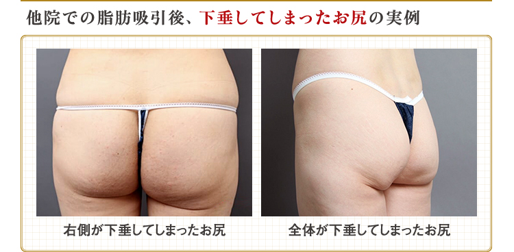 全身の脂肪吸引で人生変わった！ダウンタイム・リスク・ビフォー