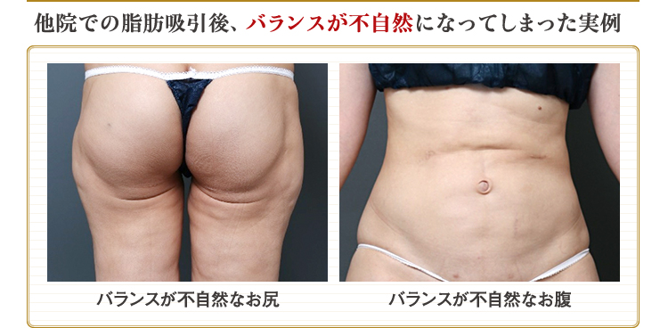 全身の脂肪吸引で人生変わった！ダウンタイム・リスク・ビフォー