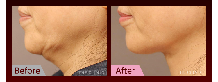 糸フェイスリフトの よくある失敗 を回避する施術とは 美容外科の医師監修コラム