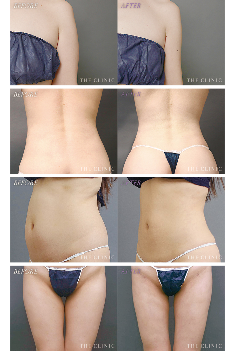 脂肪吸引で後悔しないために！よくある5つの失敗を画像で解説