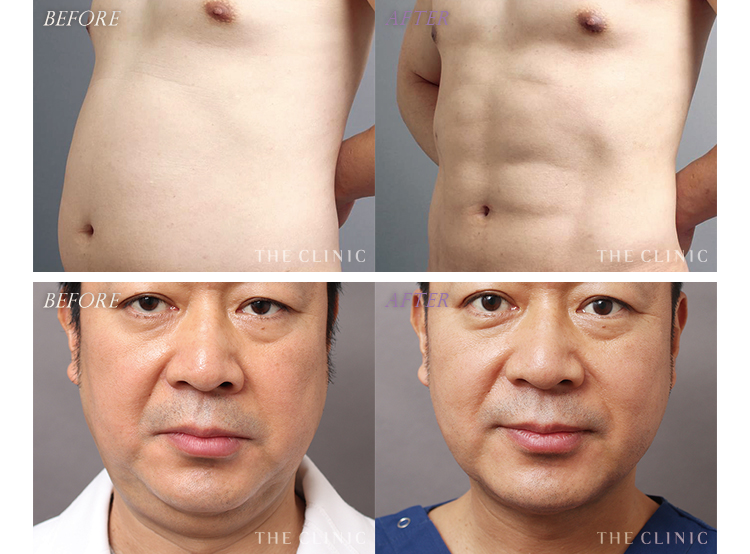 脂肪吸引で後悔しないために！よくある5つの失敗を画像で解説