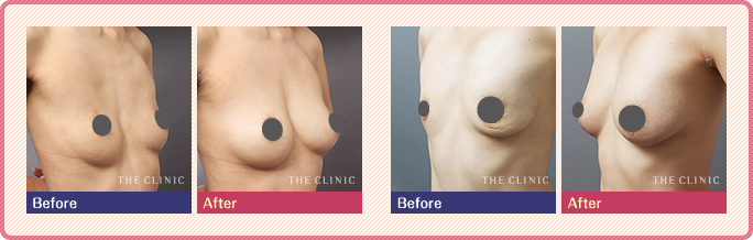 産後の胸脂肪注入豊胸の症例