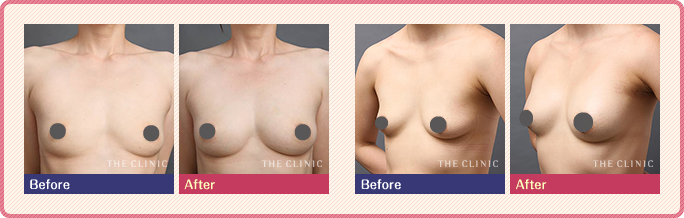 産後の脂肪注入豊胸の症例