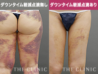 ダウンタイム軽減点滴の有無で異なる脂肪吸引後ダウンタイムの内出血の様子