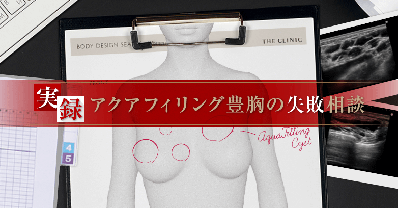 アクアフィリング豊胸の失敗事例【ジェル状充填剤の危険性】