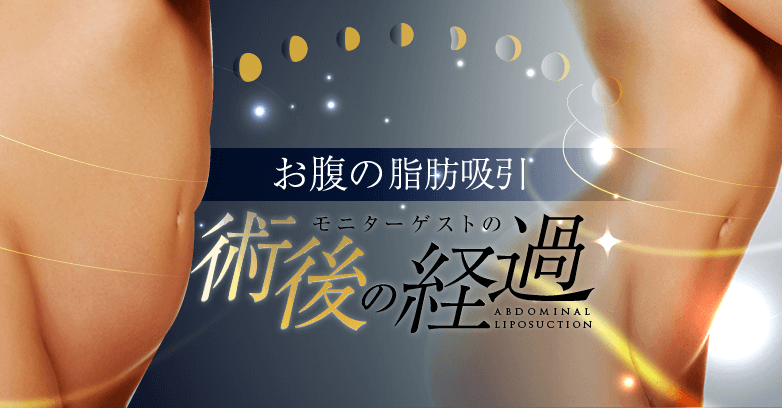 【お腹の脂肪吸引】術前術後~ダウンタイム4ヵ月の経過を追跡