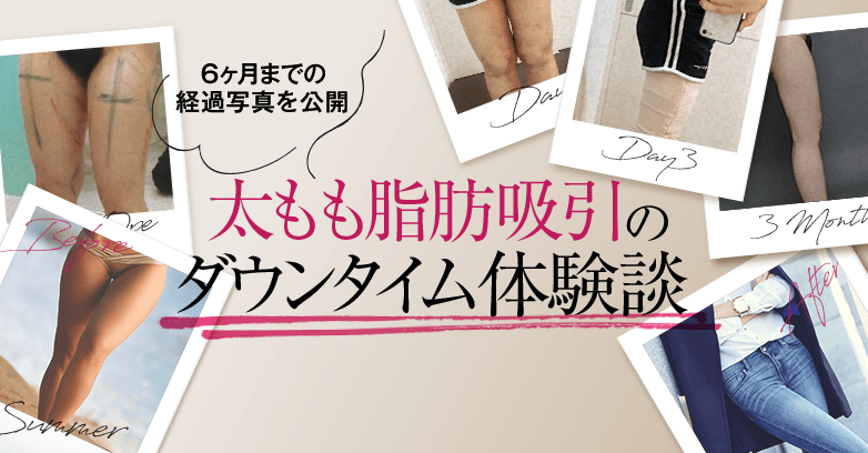 太もも脂肪吸引のダウンタイム経過報告〜6ヵ月までの写真を公開〜