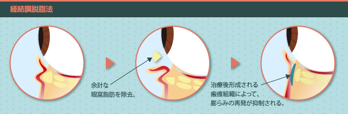 目の下のたるみ・クマ取り手術「脱脂」の方法