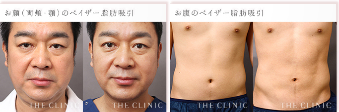 男性のお顔の脂肪吸引(両頬・顎)・お腹の脂肪吸引