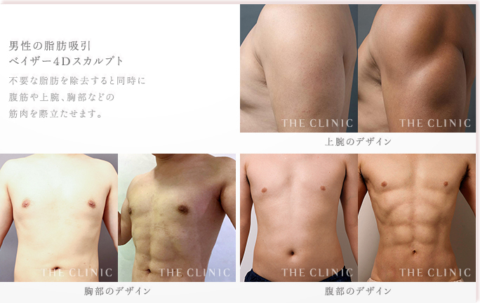 男性の脂肪吸引 ベイザー4Dスカルプト