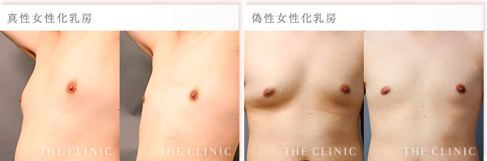 女性化乳房症例