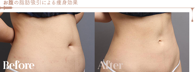 お腹の脂肪吸引による痩身効果