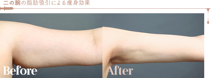 二の腕の脂肪吸引による痩身効果