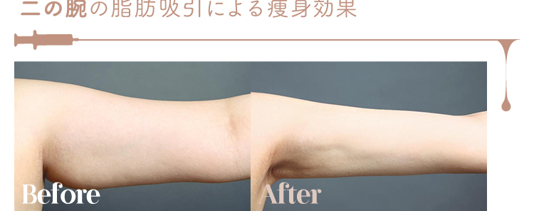 脂肪溶解注射の効果とリスクを検証 顔 二の腕 太もも お腹 医師監修コラム 脂肪溶解注射の効果とリスクを検証 顔 二の腕 太もも お腹 医師監修コラム