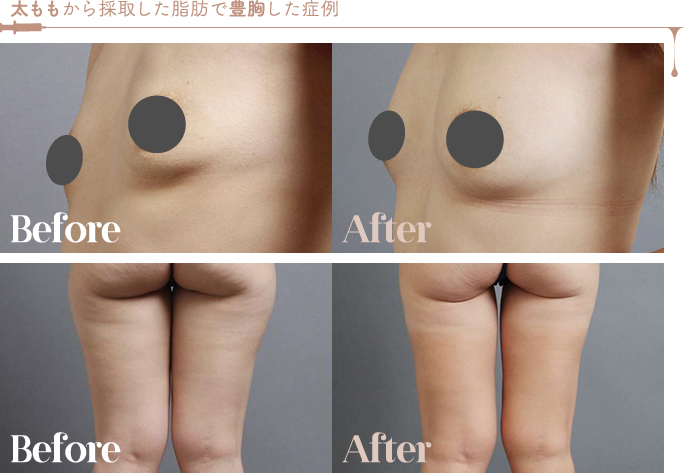 太ももから採取した脂肪で豊胸した症例