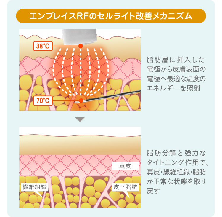 セルライト除去は自分でできるの? 脂肪専門医が原因となくす方法を解説