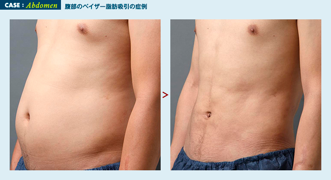 男性のお腹の脂肪吸引