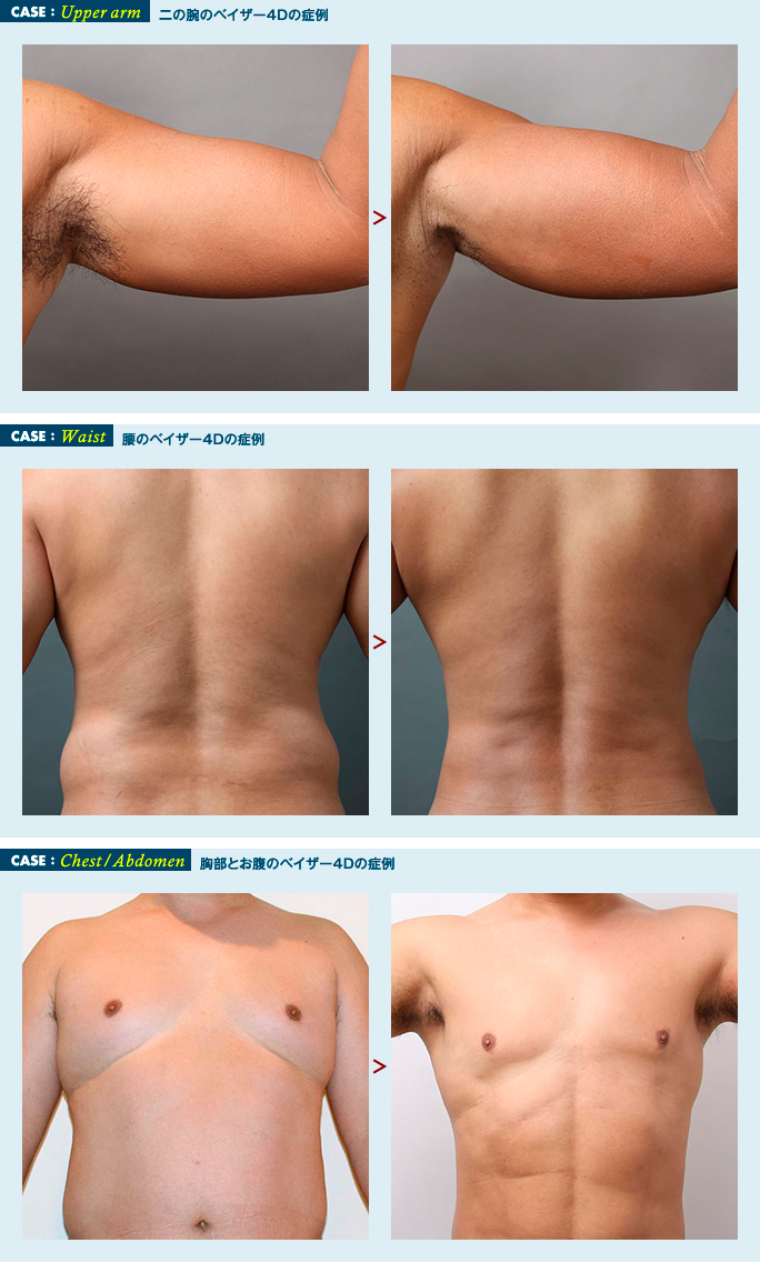 男性の脂肪吸引
