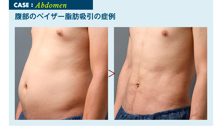 男性 メンズ 脂肪吸引モニターの実態調査 美容外科の医師監修コラム
