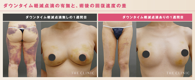 ダウンタイム軽減点滴の有無と術後の回復速度の差