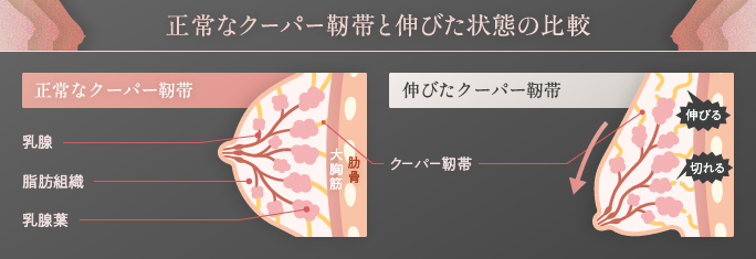正常なクーパー靭帯と伸びた状態の比較