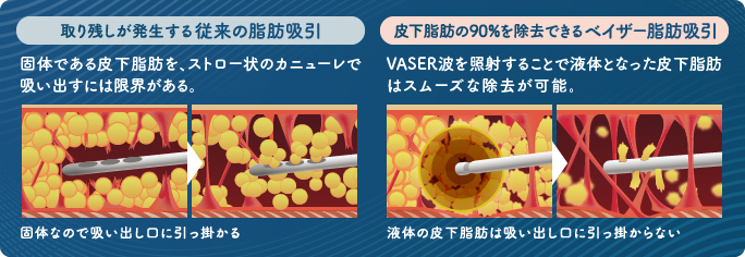 効率的に脂肪を採取するベイザー脂肪吸引