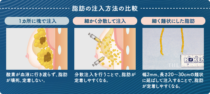 脂肪は細かく層状にして胸に注入"