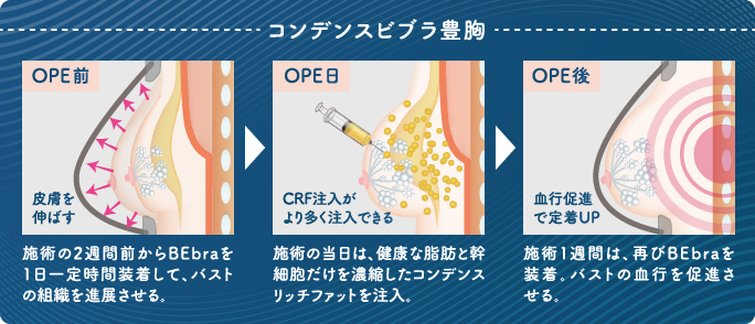 バストへの注入スペースをしっかり確保