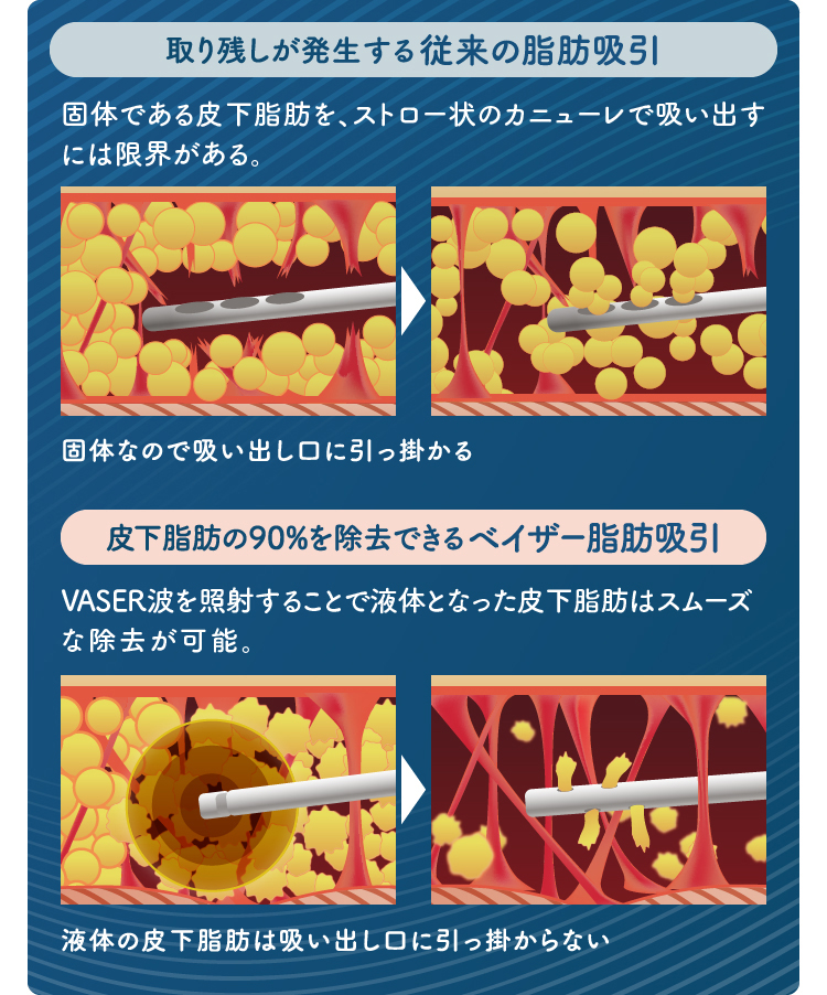 貧乳 小胸さん必見 胸に脂肪をつける育乳法を脂肪専門医が伝授