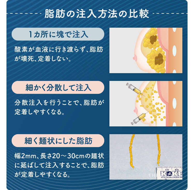 貧乳 小胸さん必見 胸に脂肪をつける育乳法を脂肪専門医が伝授