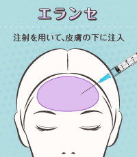 エランセ注入