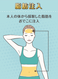 脂肪注入