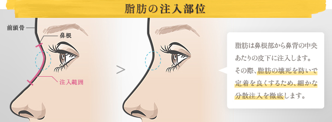 脂肪の注入部位