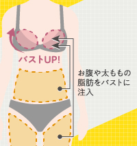 脂肪注入豊胸の説明