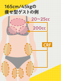 脂肪豊胸の痩せ型ゲストの脂肪吸引箇所と注入量の例