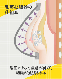 乳房拡張器の仕組み