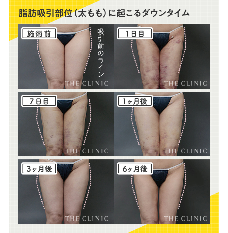 脂肪豊胸の​デメリット4選｜後悔しないために​知っておくべき対処法